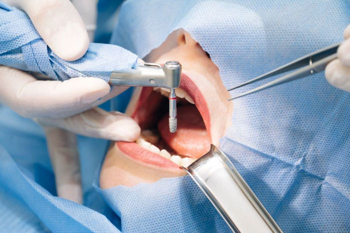 Đặt trụ Implant vào trong xương hàm