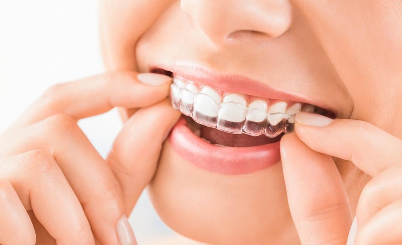 Đeo máng chống nghiến khi ngủ giảm tải áp lực cho răng sứ