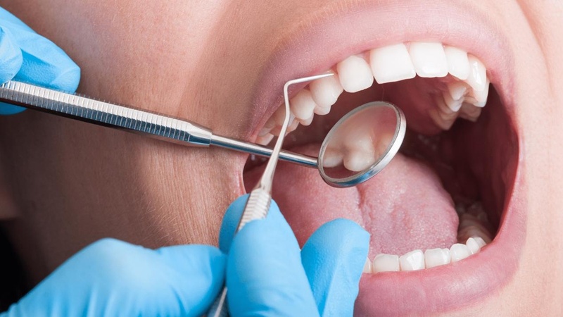 Điều trị dứt điểm nướu răng bị đen tại nha khoa uy tín