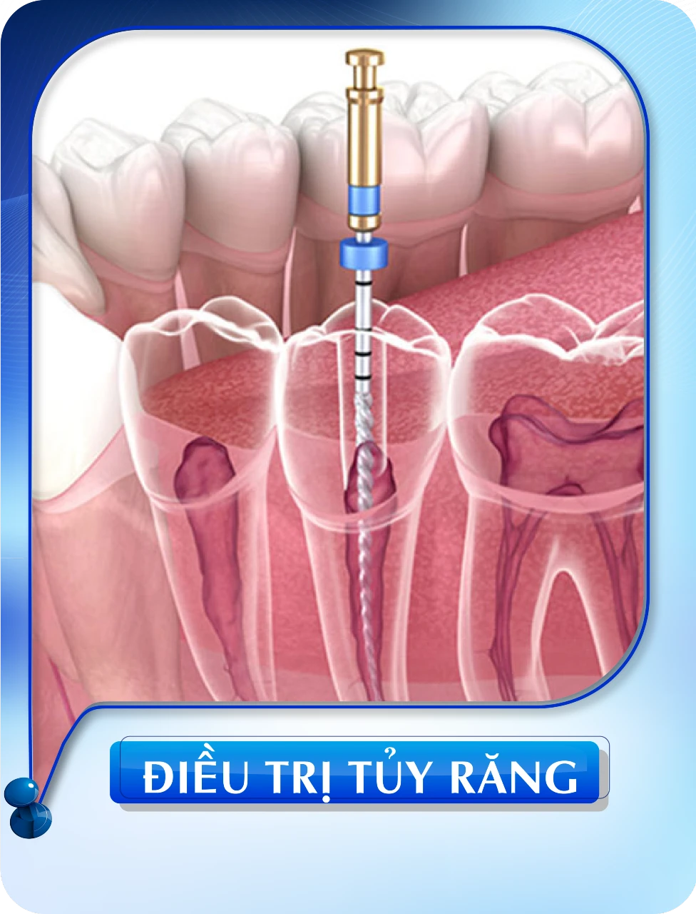 Điều trị tủy răng