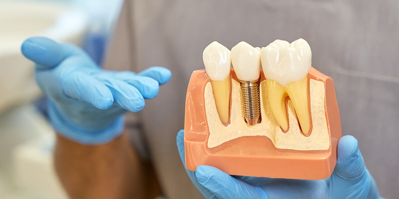 Giải pháp cấy ghép Implant mang lại nhiều lợi ích