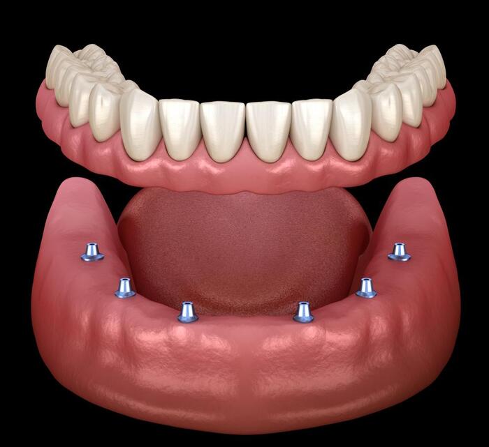 Hàm phủ trên Implant