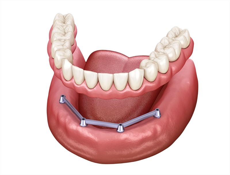 Hàm tháo lắp trên Implant có thanh bar