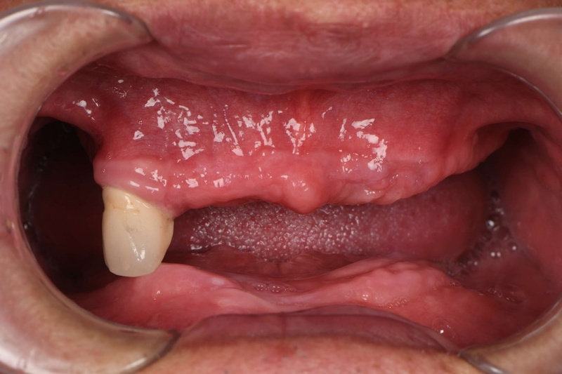 Hàm tháo lắp trên Implant có thể áp dụng cho người mất răng toàn hàm
