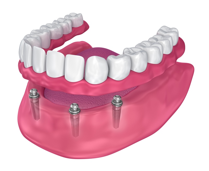 Hàm tháo lắp trên Implant dạng khóa cài bằng bi