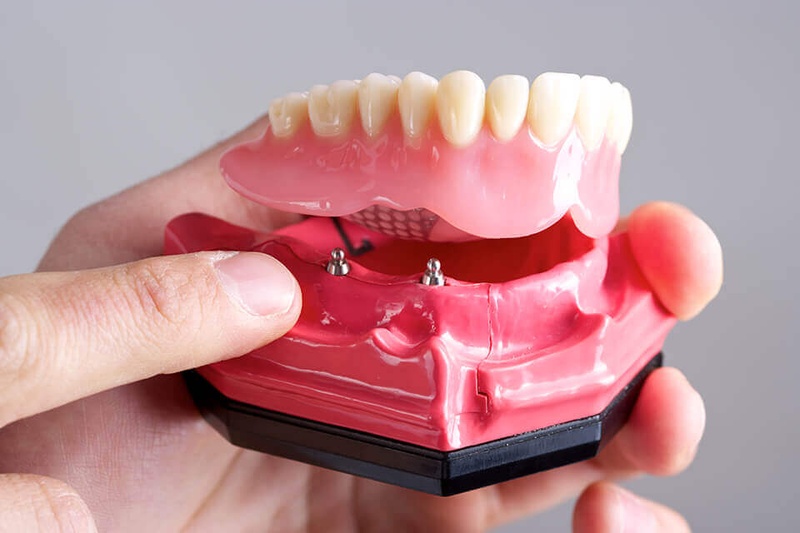 Làm răng giả tháo lắp trên Implant là phương pháp kết hợp giữa trụ Implant và hàm giả tháo lắp