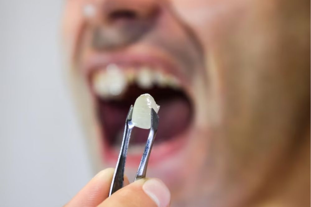 Sau nhổ răng lựa chọn thời điểm cấy ghép cần xét nhiều yếu tố
