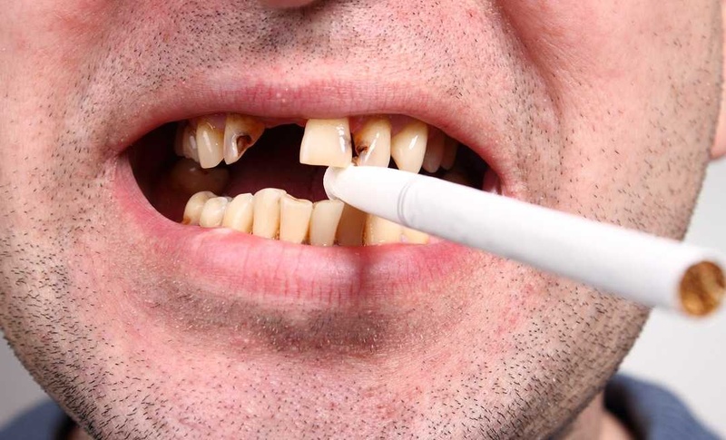 Hút thuốc lá nguyên nhân chính trực tiếp gây mất răng