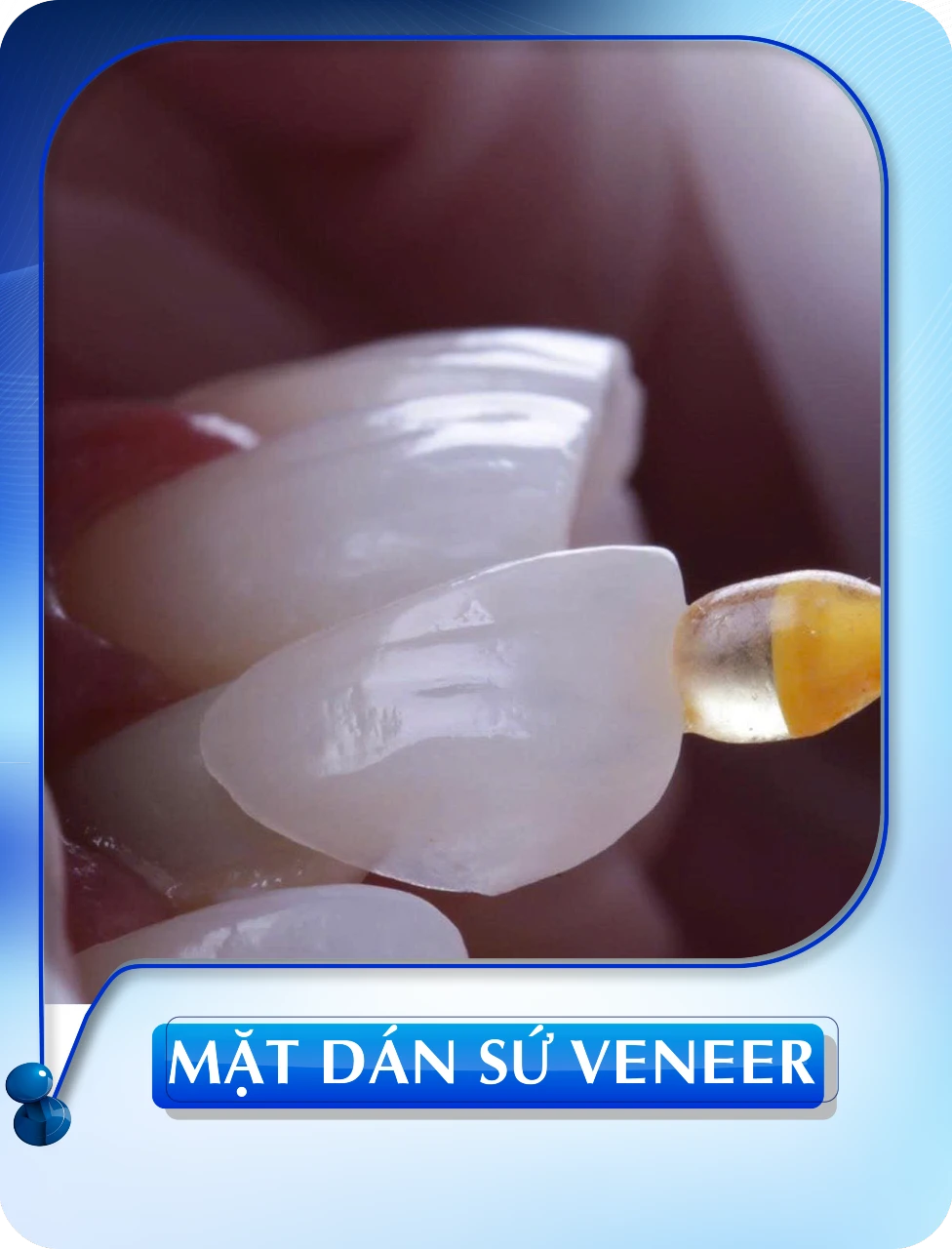 Mặt dán sứ Veneer