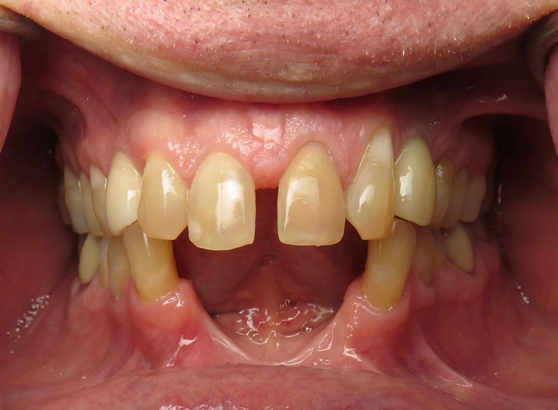 Mất răng không trồng sớm có thể tiêu xương hàm trầm trọng