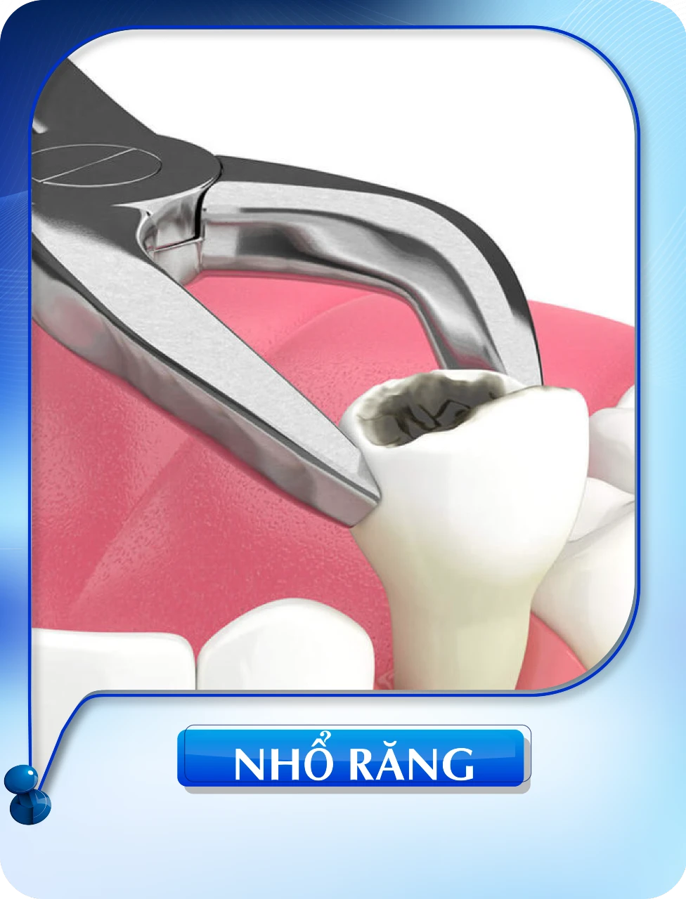 Nhổ răng