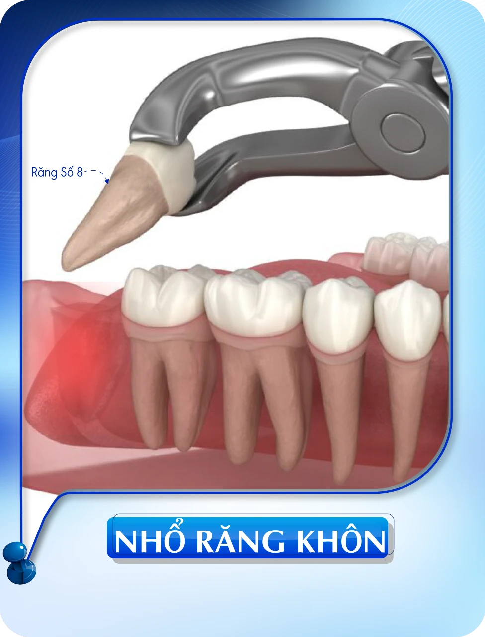 Nhổ răng khôn