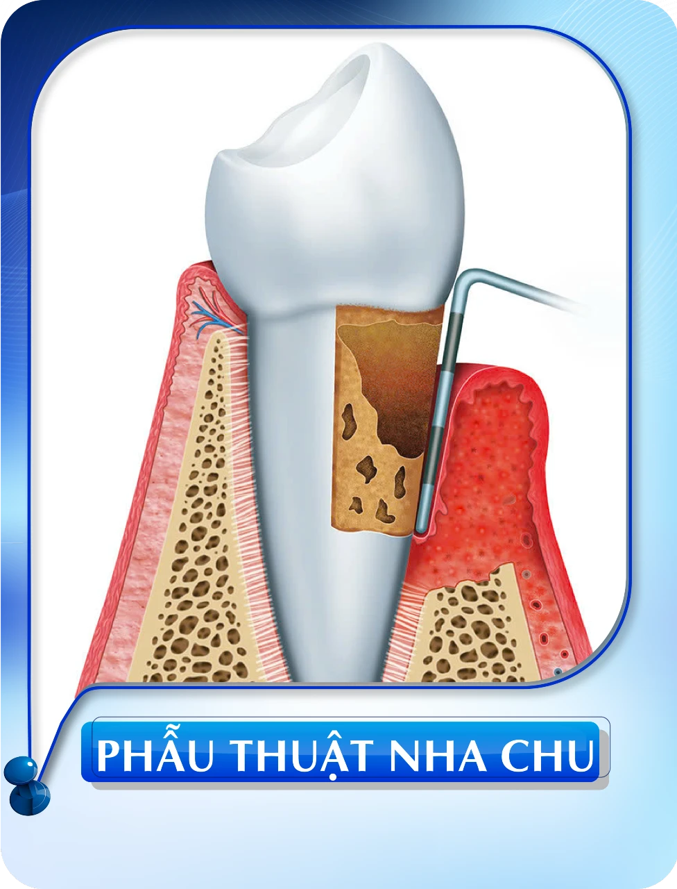 Phẫu thuật nha chu