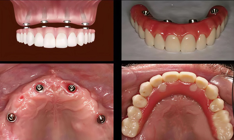Phục hình hàm giả tháo lắp trên Implant