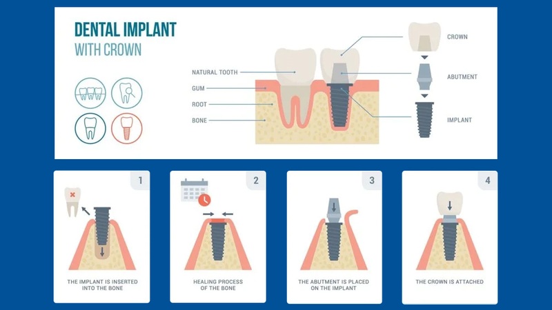 Quy trình gắn Abutment trên Implant