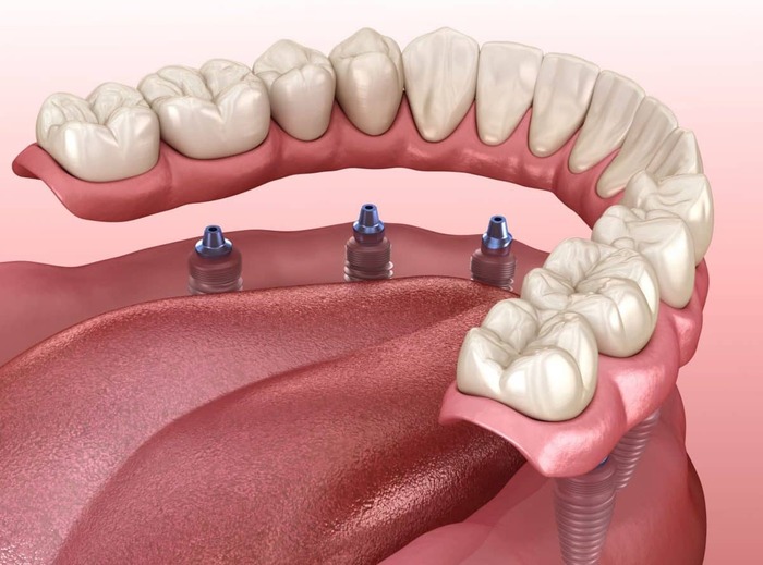 Làm răng giả trên Implant được xem là một giải pháp tốt và tối ưu trong một số trường hợp nhất định