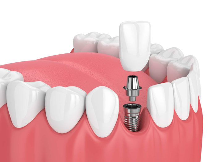 Răng Implant có cấu tạo tương tự như răng thật