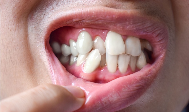 Răng mọc lệch lạc nặng sẽ không thể bọc răng sứ hiệu quả