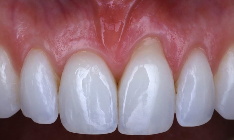 Răng sứ bị tụt lộ cùi răng