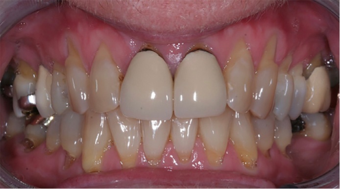 Răng sứ kim loại gây mất thẩm mỹ và tăng khả năng mắc bệnh lý
