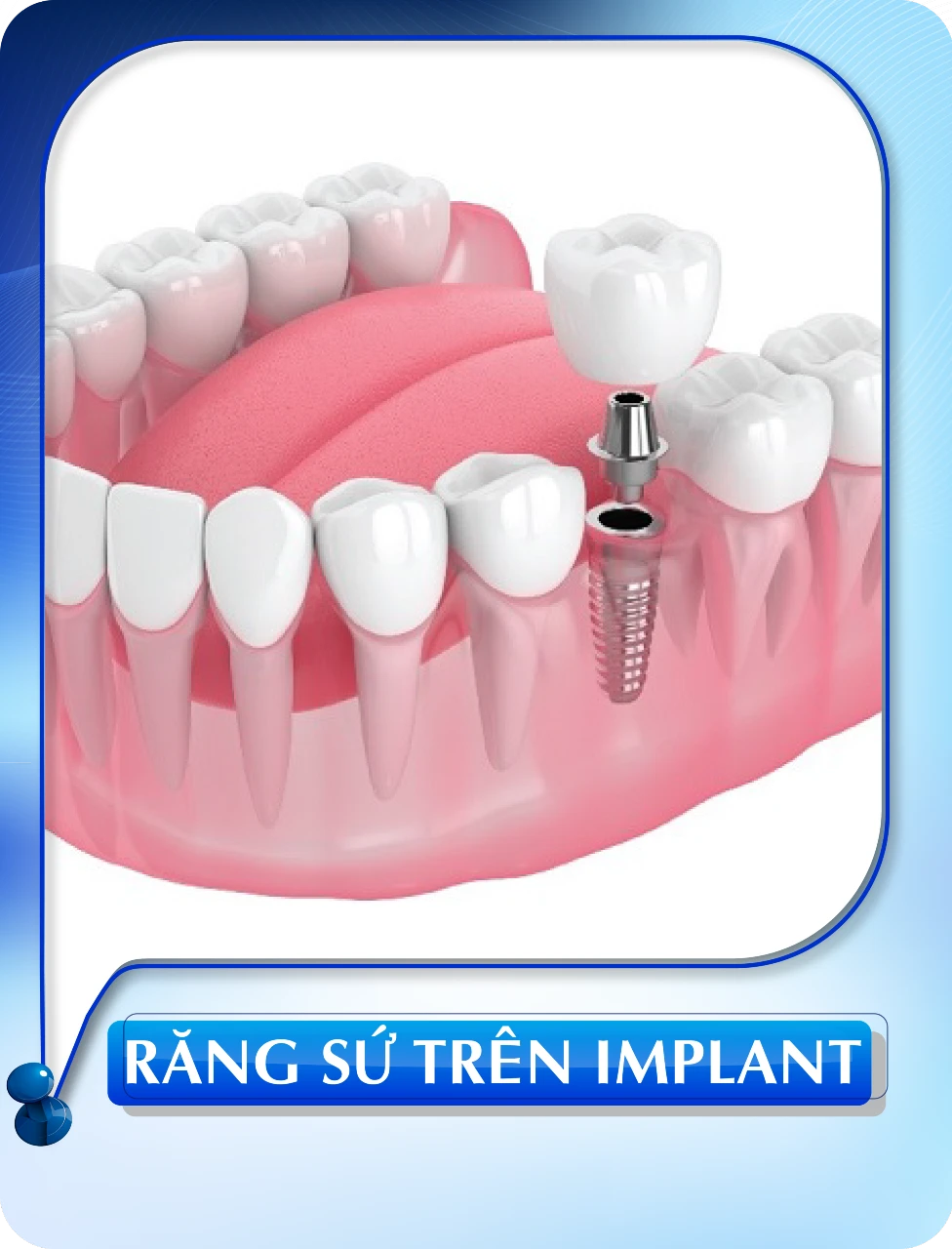 Răng sứ trên implant