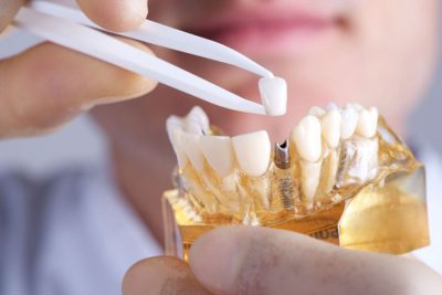 răng tạm trên implant