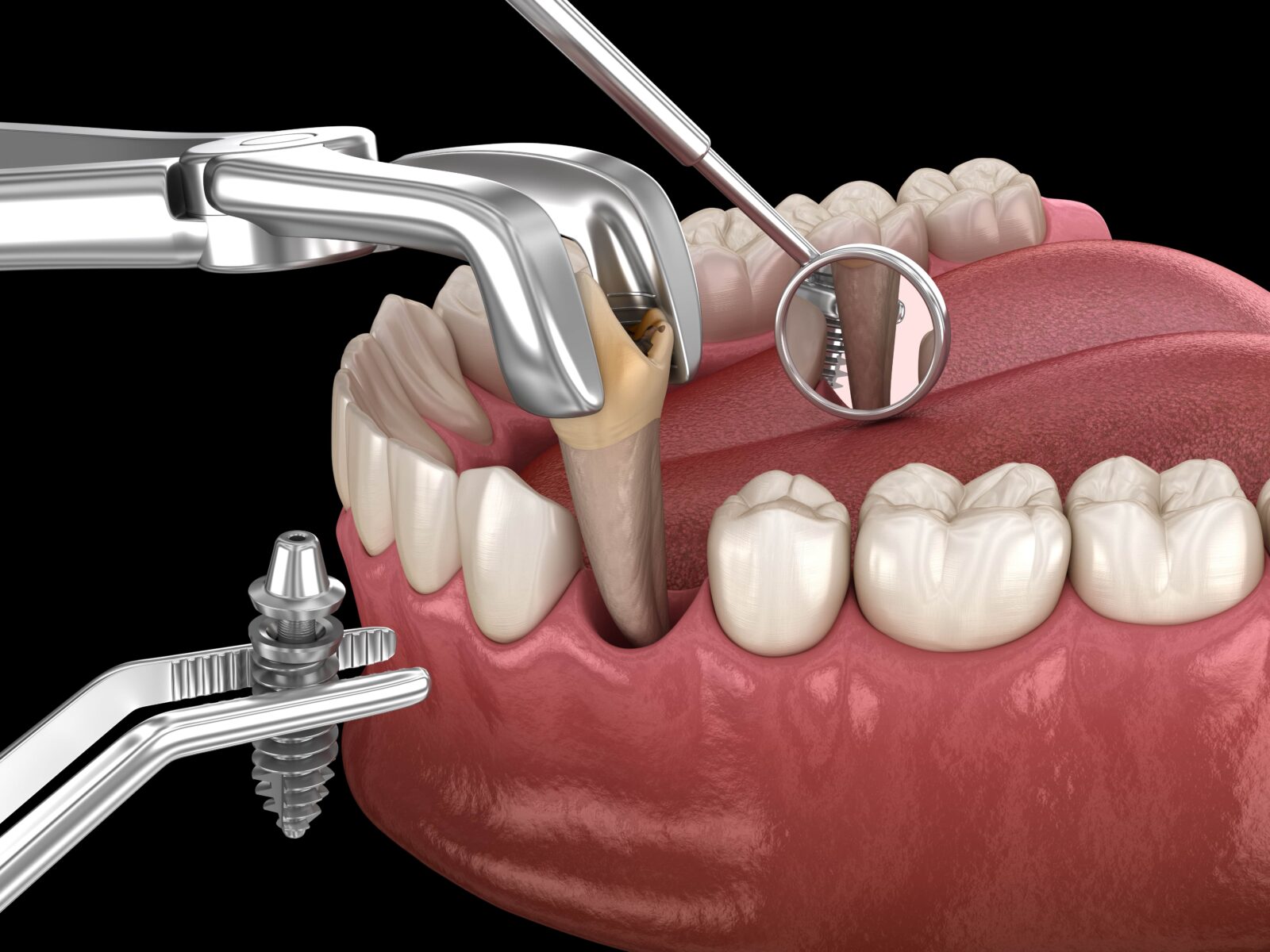 Cấy ghép Implant tức thì ngay sau khi nhổ răng