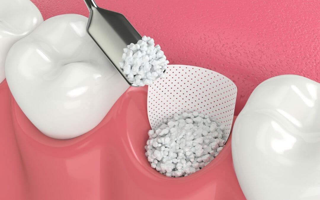 Nhiều trường hợp cần ghép xương khi cấy ghép Implant quá lâu