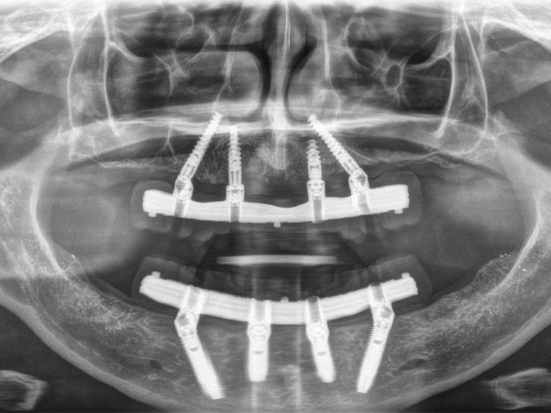 Số lượng trụ Implant cần cấy ghép cũng quyết định đến chi phí trồng răng Implant