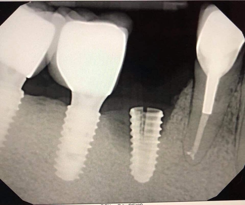 Sử dụng trụ Implant kém chất lượng có thể gây nứt trụ