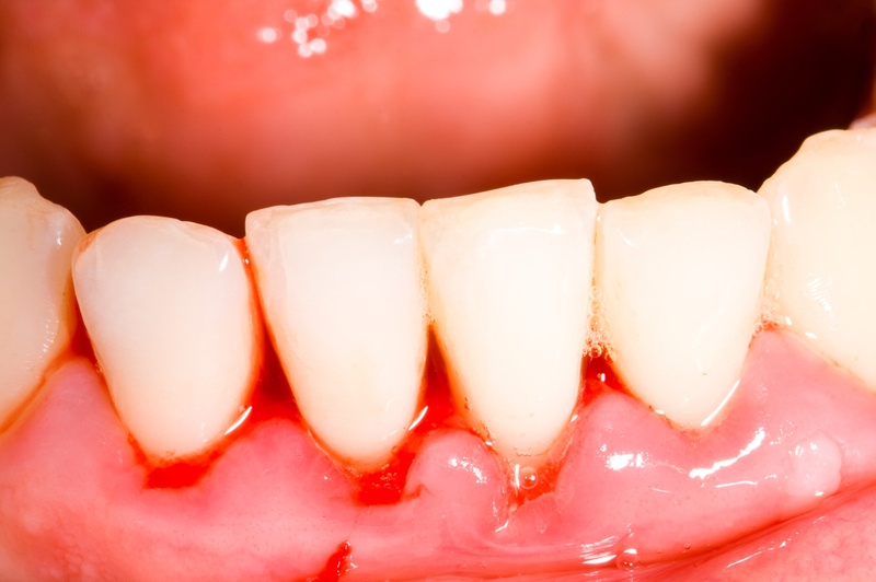 Thai phụ dễ chảy máu nướu răng hơn bình thường