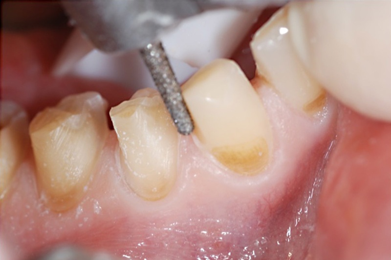 Thao tác mài cùi răng sai kỹ thuật xâm lấn cấu trúc răng