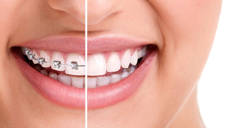 Theo các chuyên gia nha khoa, sau khi bọc răng sứ vẫn có thể niềng răng được
