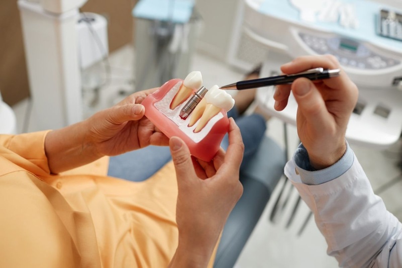 Tìm hiểu kỹ tất cả thông tin về Implant