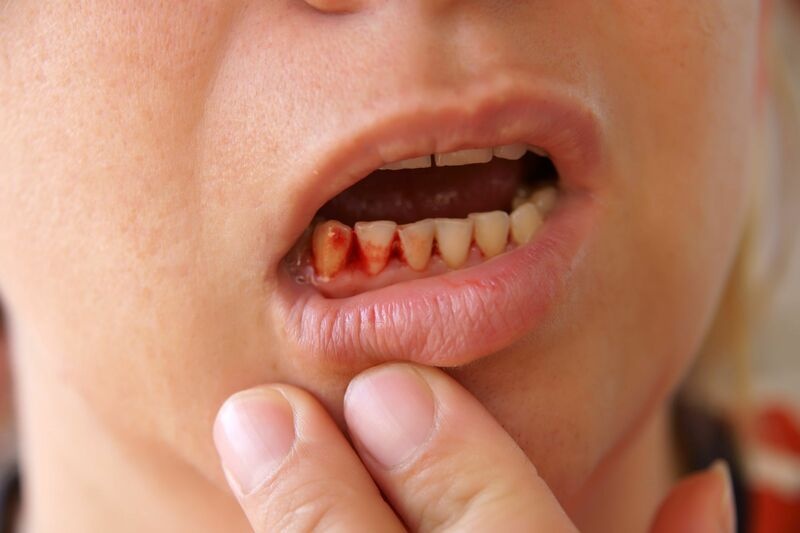 Tình trạng chảy máu kéo dài sau khi cấy ghép Implant