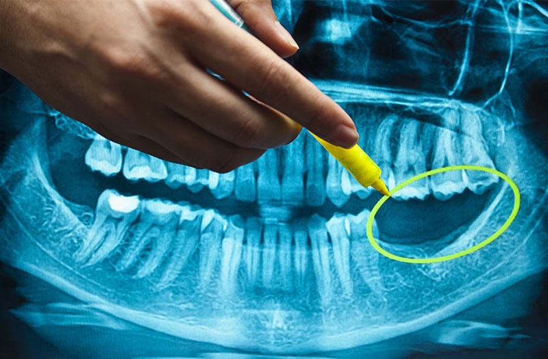 Tình trạng xương hàm là một trong những yếu tố ảnh hưởng đến chi phí trồng Implant
