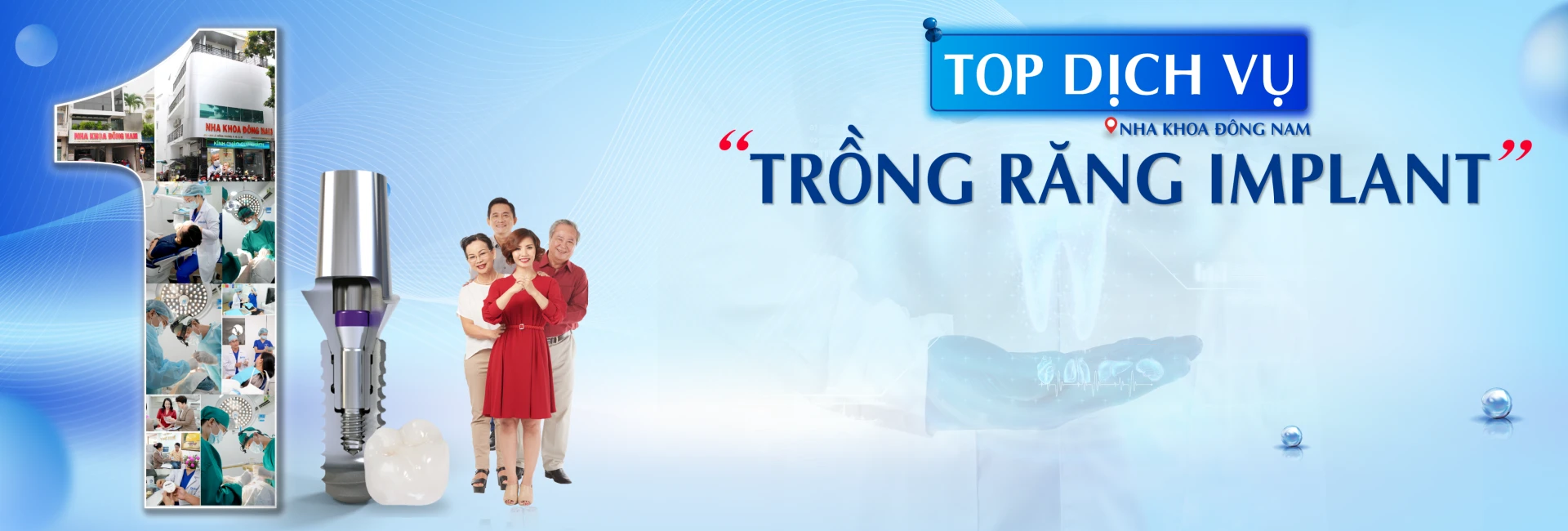 Top dịch vụ trồng răng implant