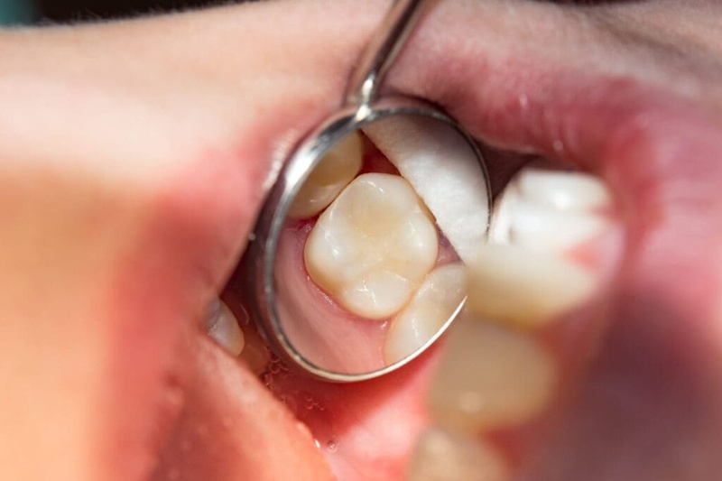 Trám răng Composite cho thai phụ