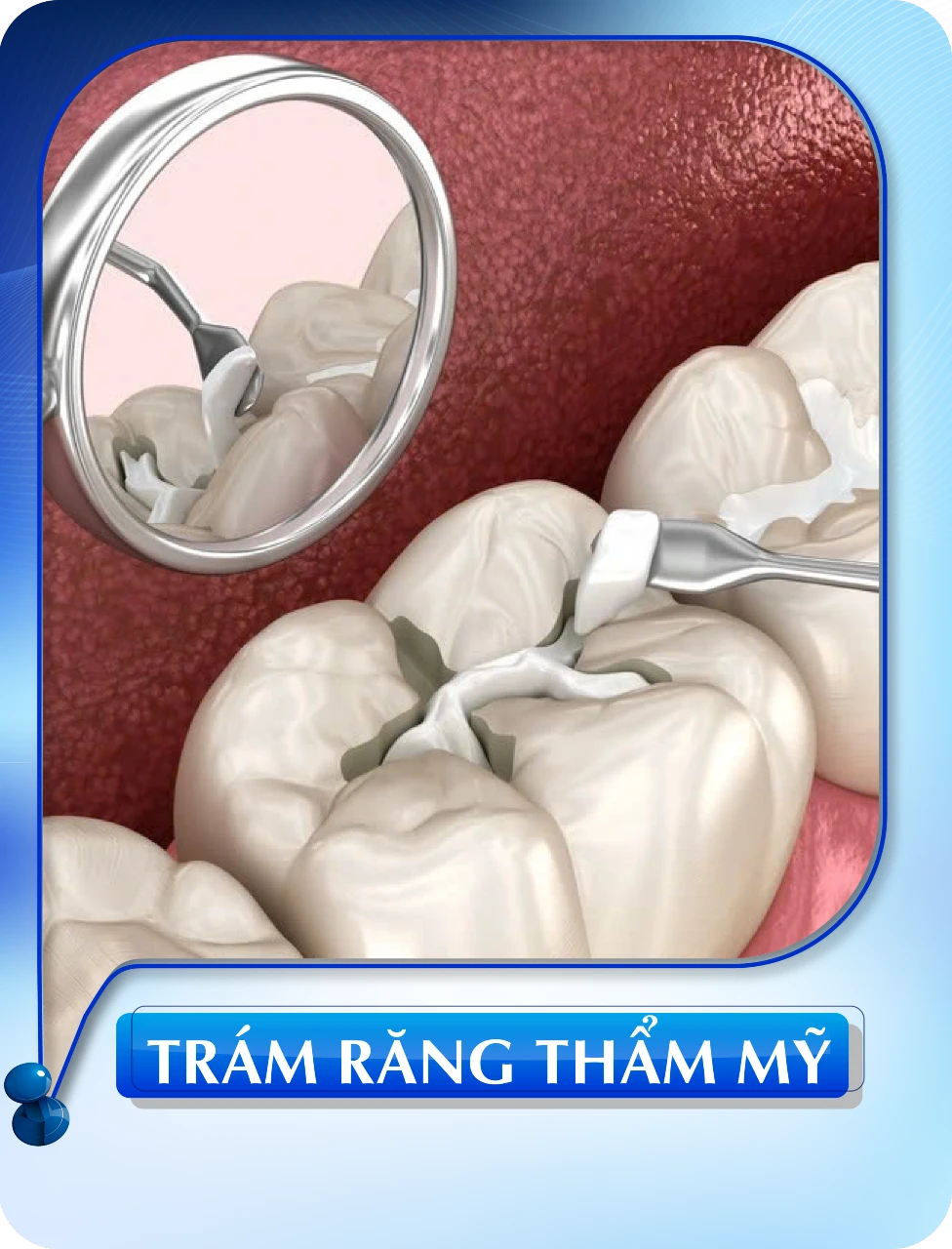 Trám răng thẩm mỹ