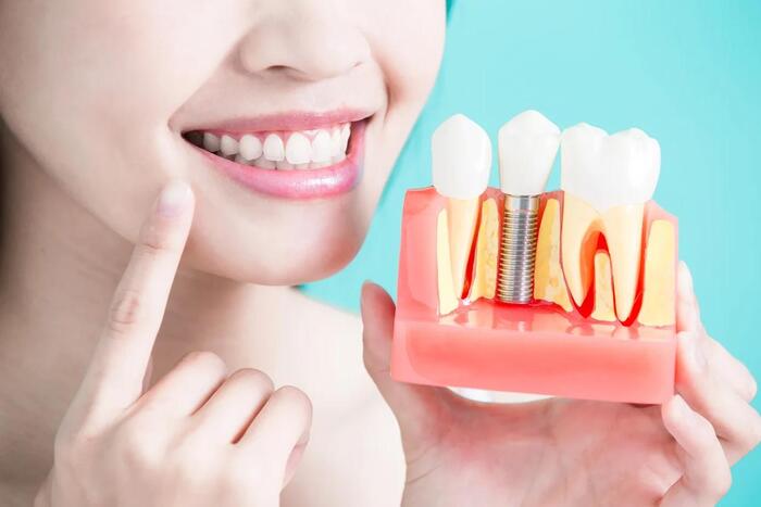 Thời gian hồi phục sau khi trồng răng implant thường kéo dài từ 3 đến 6 tháng