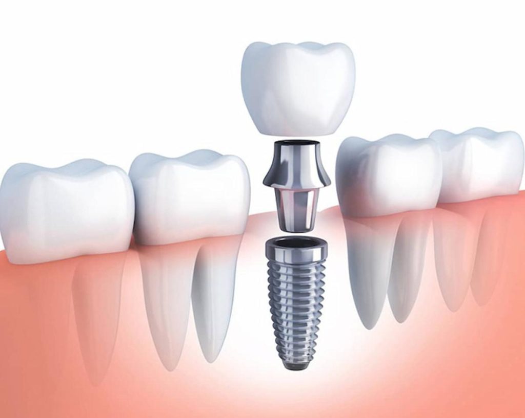 trồng răng implant có đau không