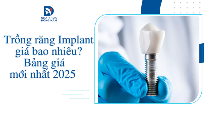 Trồng răng Implant giá bao nhiêu?