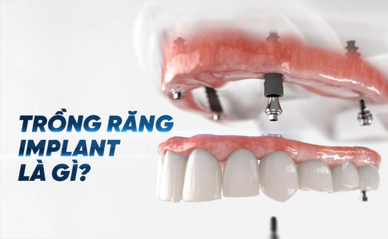 Trồng răng Implant khôi phục răng mất toàn diện
