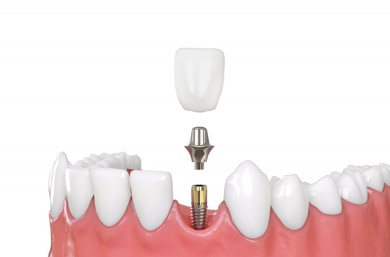 Trồng răng Implant phục hình răng toàn diện
