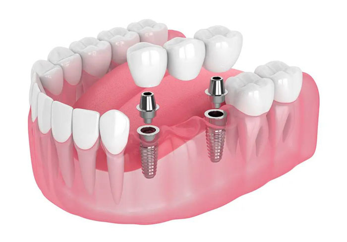 Trồng răng Implant thay thế mất nhiều răng liên tiếp