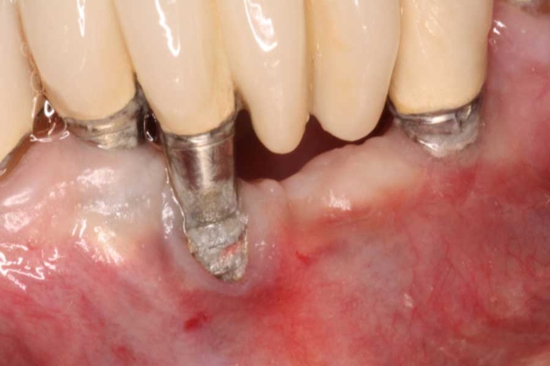 Trụ Implant kém chất lượng là yếu tố nguy cơ gây viêm nhiễm Implant