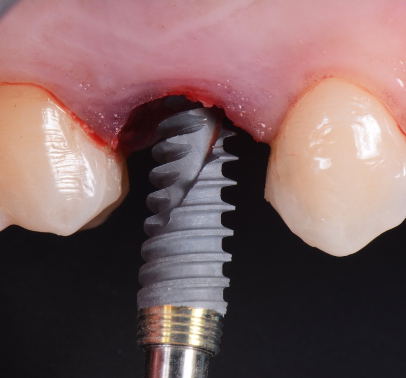 Trụ Implant Nobel tăng tỷ lệ thành công kể cả những trường hợp xương yếu