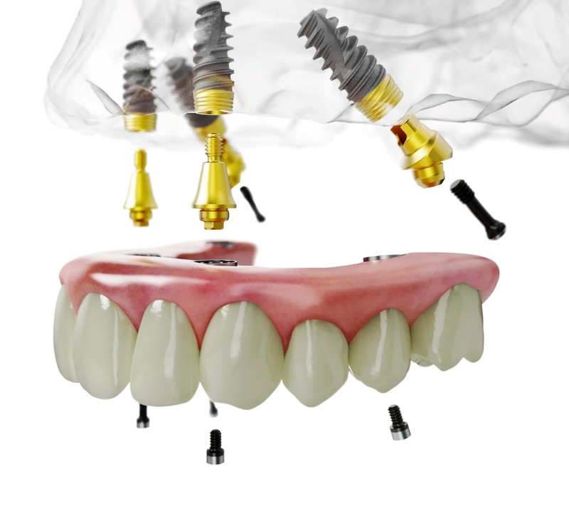 Trụ Implant Nobel thích hợp cho trường hợp trồng All-on-4