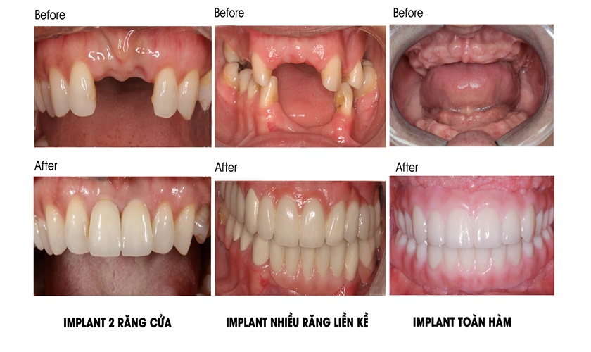 Các trường hợp nên cấy ghép Implant