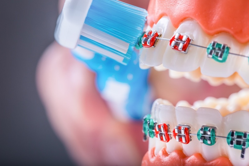 Vệ sinh răng miệng khi niềng răng trên nền răng sứ